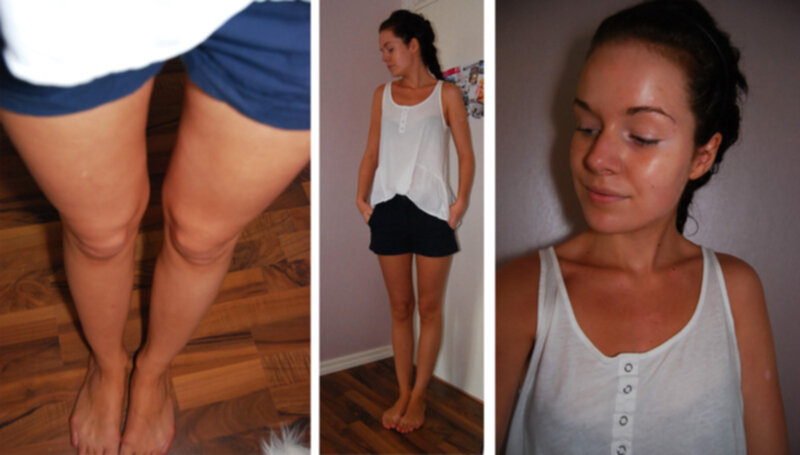 brun utan sol vitiligo brun utan sol vitiligo